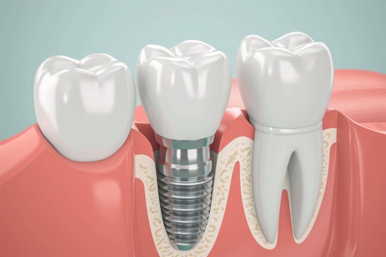 implante-dentario-lisboa-clinica-bernardete-almeida