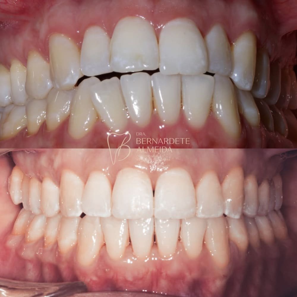 Antes e depois de tratamento Invisalign com ortodontista em Lisboa